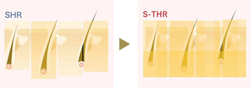 SHRのデメリットをカバーしたS-THRは脱毛効果で絶大
